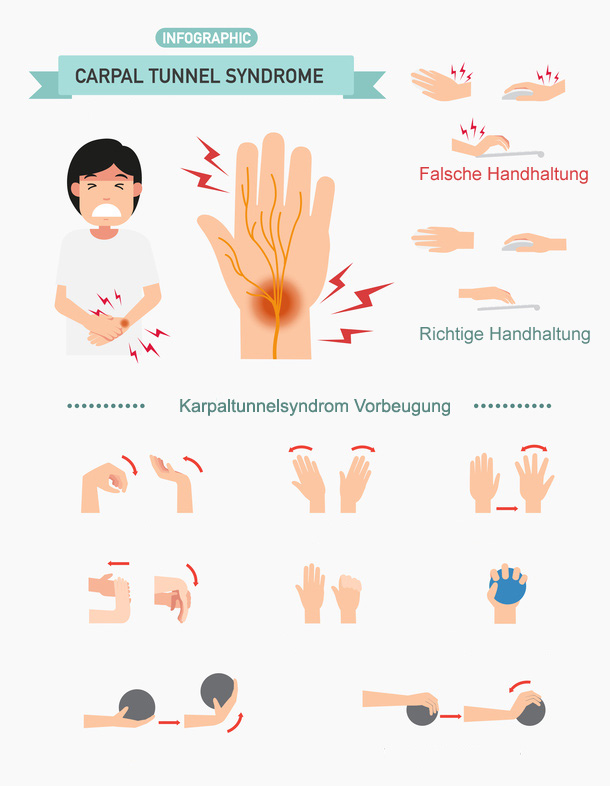 Monotone Handbewegungen können das Risiko einer Karpaltunnelverengung erhöhen. Mithilfe von Ausgleichsübungen senken Sie Ihr Risiko, an einem Karpaltunnelsyndrom zu erkranken. Hilfreich sind Dehnungsübungen in vertikale und horizontale Richtung, Kräftigung des Handgelenks, Fingerspreizen und Kräftigung der Finger durch Knautschbälle. ©Jehsomwang @fotolia