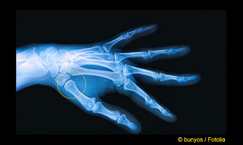 Röntgenuntersuchung des Daumensattelgelenks: Bei einer Arthrose ist nur noch ein sehr schmaler oder gar kein Gelenkspalt des Daumensattelgrundgelenks zu sehen. In diesem Röntgenbild liegt ein ausreichender Gelenkspalt vor (gelber Kreis). Bei Rhizarthrose ist außerdem das Daumensattelgelenk verformt. Am Rand des Gelenks bilden sich Osteophyten (Knochensporne), die das Gelenk zusätzlich aufrauen und den Knorpelverschleiß beschleunigen. © bunyos / Fotolia