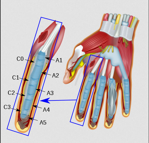 Schnappfinger (Tendovaginitis stenosans) ist die Blockade der Fingersehne durch Knötchenbildung. Die Knötchen können nur nach hohem Kraftaufwand über die festen, horizontal verlaufenden Ringbänder gleiten. Die Ringbänder "fesseln" die Fingersehnen in die Gelenke, so dass sie nicht bogensehnenartig herausstehen. Meistens ist das erste von 5 Ringbändern des Fingers (in der Grafik: A1) von der Tendovaginitis stenosans betroffen. Die Knötchenbildung wird also immer ausgelöst durch eine entzündliche Einengung der Sehnenscheiden der Fingerbeugesehnen. © anka friedrichs @ wikimedia