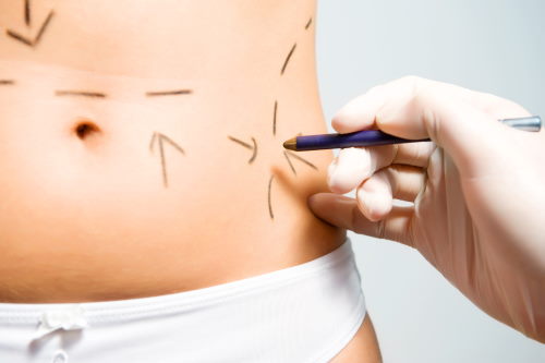 Chirurg zeichnet zur OP-Planung Orientierungslinien auf die Haut einer Patientin.